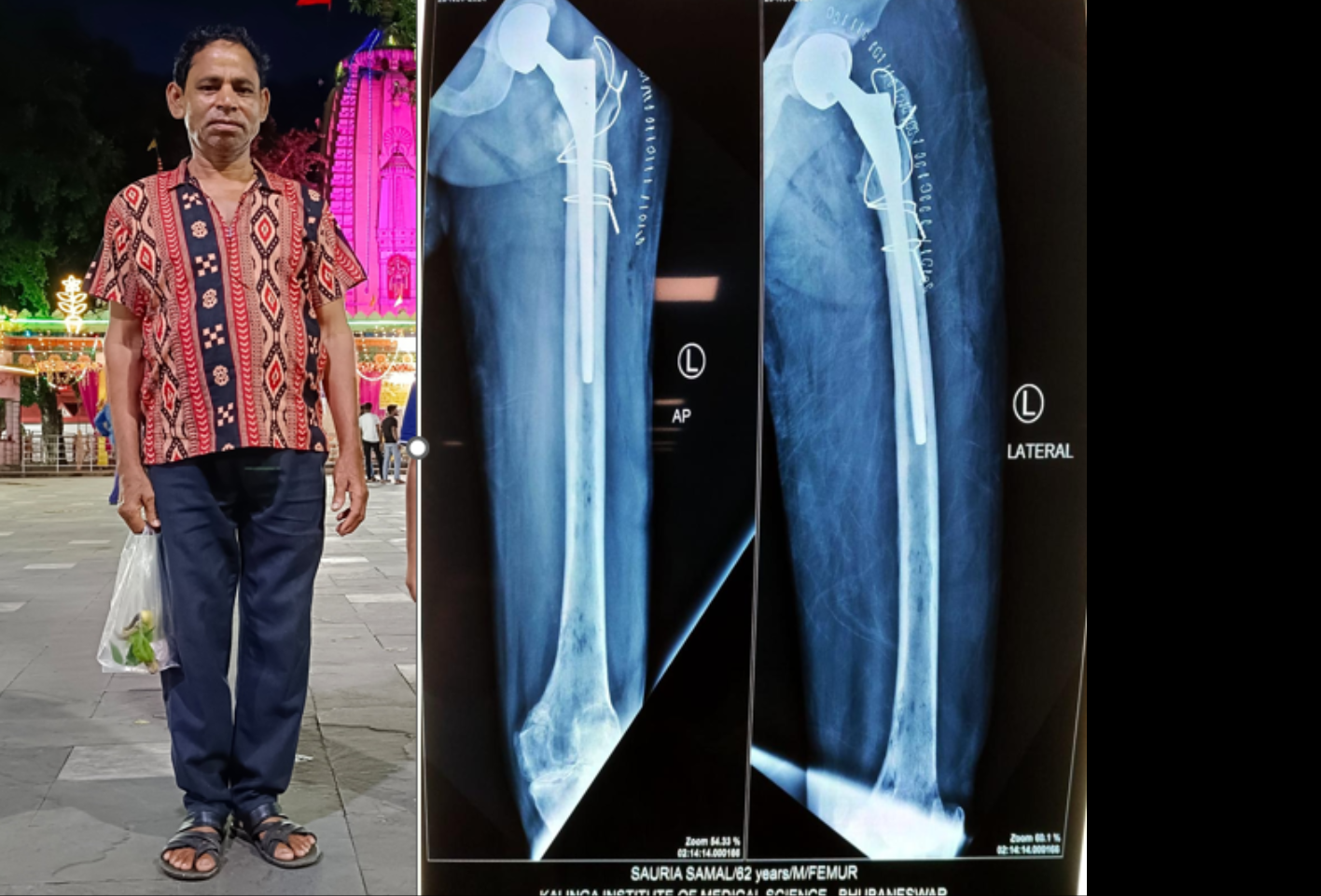 Free Hip replacement for a poor cancer patient.